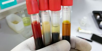 Photo of Common types of blood serum sample errors. Hemolyzed, icteric, lipemic and normal type of serum