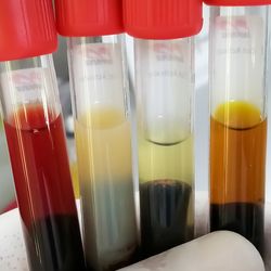 Photo of Common types of blood serum sample errors. Hemolyzed, icteric, lipemic and normal type of serum