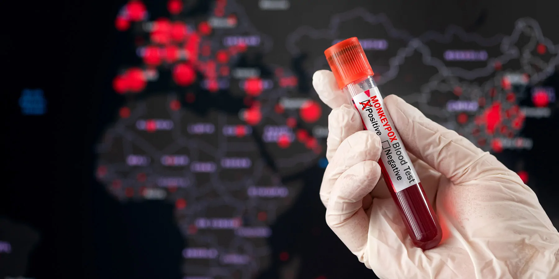 Monkeypox positive blood tube and world pandemic map