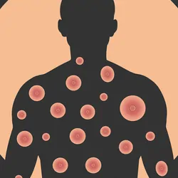 Banner of monkeypox virus on black background