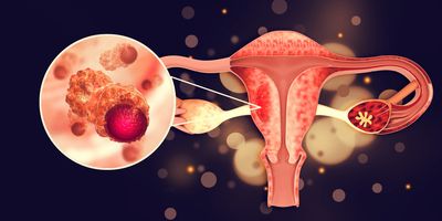 Uterus cancer and endometrial malignant tumor, render