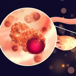 Uterus cancer and endometrial malignant tumor, render