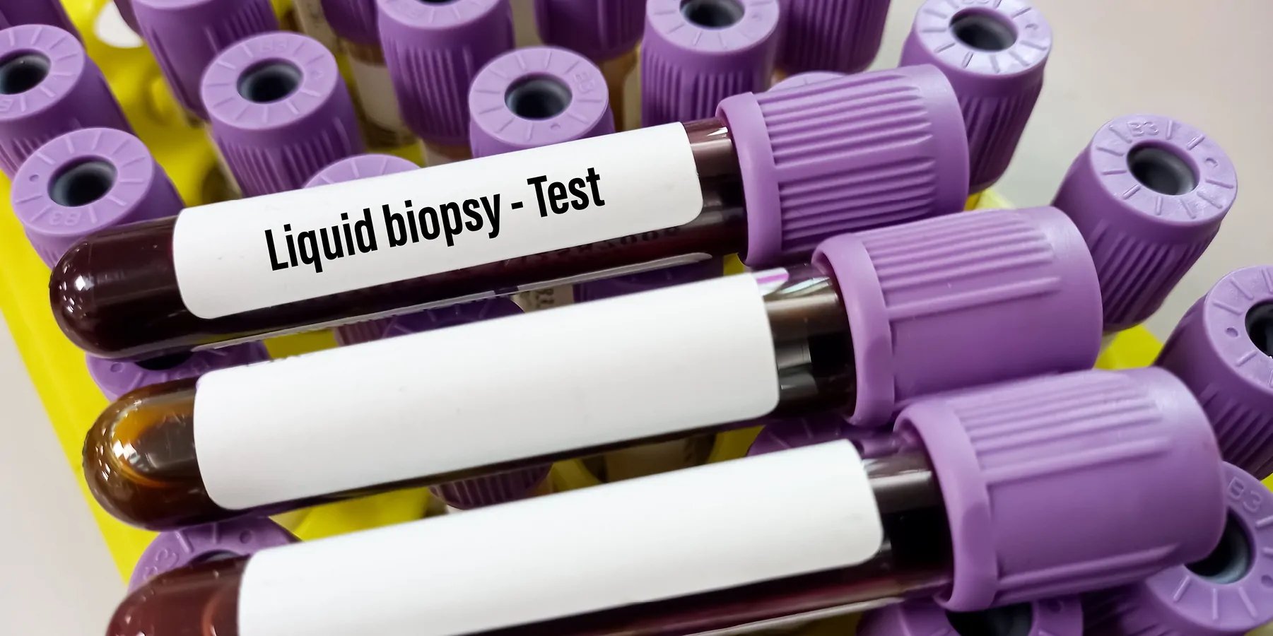 Blood samples in tubes labeled for liquid biopsy