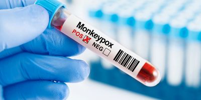 Photo of a clinical lab professional wearing gloves holding a monkeypox sample.