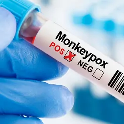 Photo of a clinical lab professional wearing gloves holding a monkeypox sample.