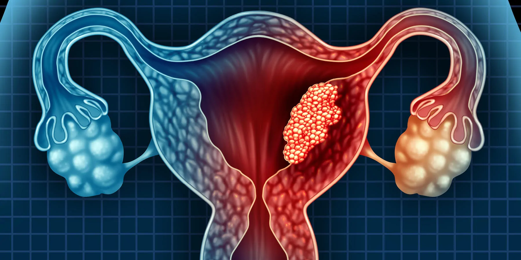 Hair Straightening Chemicals Associated with Higher Uterine Cancer Risk Computer image of a tumor on the uterin wall