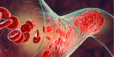 Computer image of a blood clot of red blood cells
