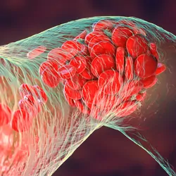 Computer image of a blood clot of red blood cells