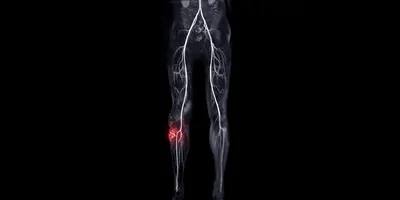 X-ray image of human legs with blood vessels visible on black background