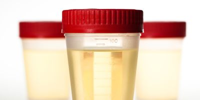 Three sample containers with urine samples in them on a white background