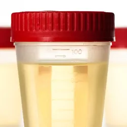 Three sample containers with urine samples in them on a white background