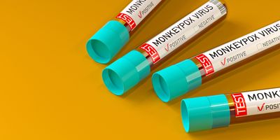 Four blood vials marked monkeypox positive