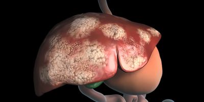 Computer image of human liver with cancer