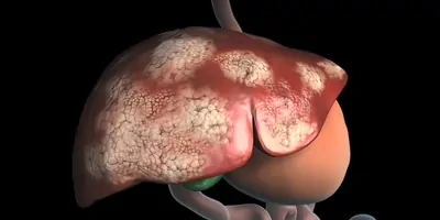 Computer image of human liver with cancer