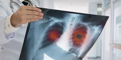 Doctor holding an x-ray of lungs