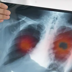 Doctor holding an x-ray of lungs