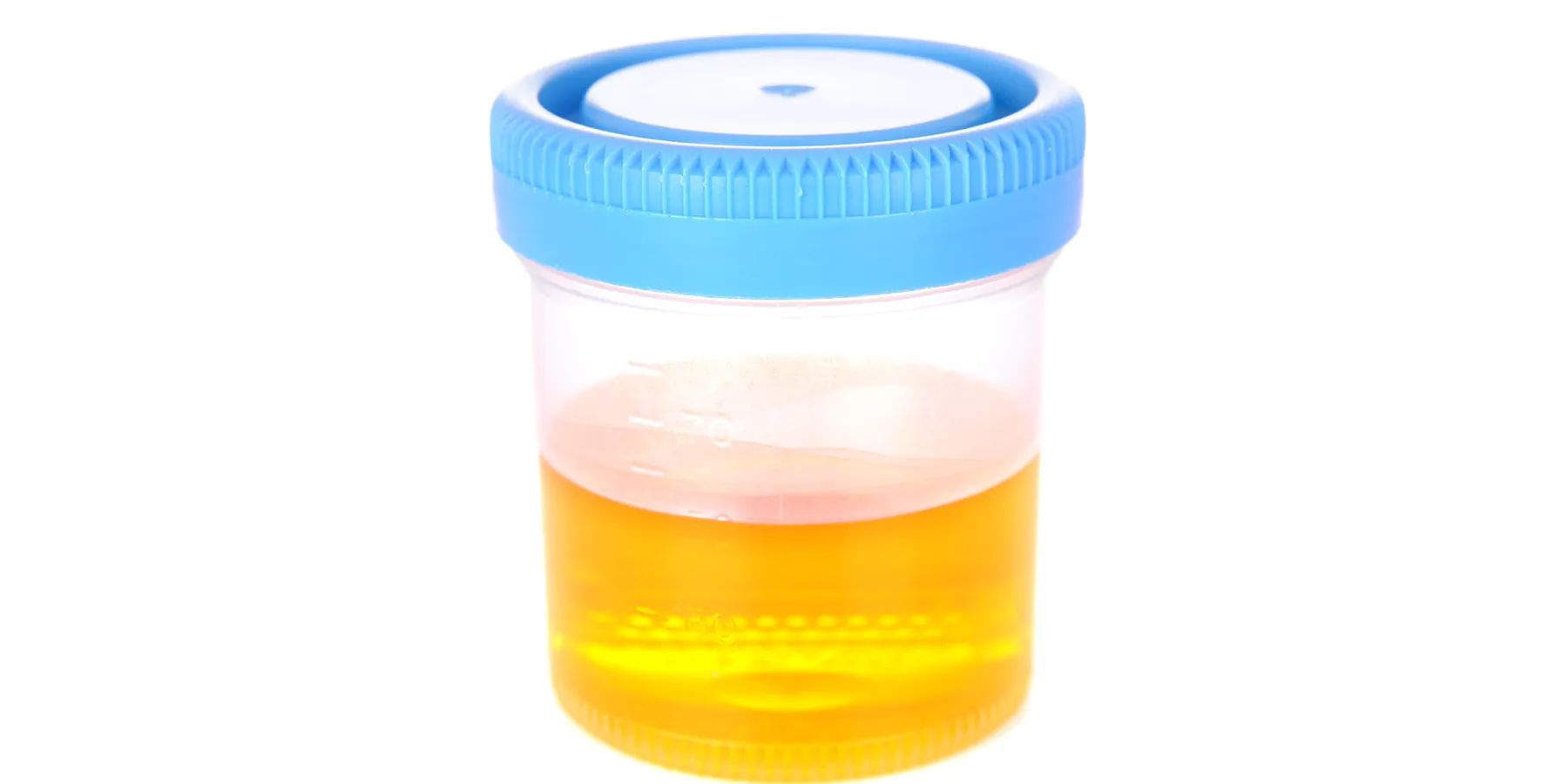 Urine cup with urine in it on a white background