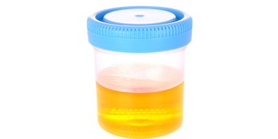Urine cup with urine in it on a white background
