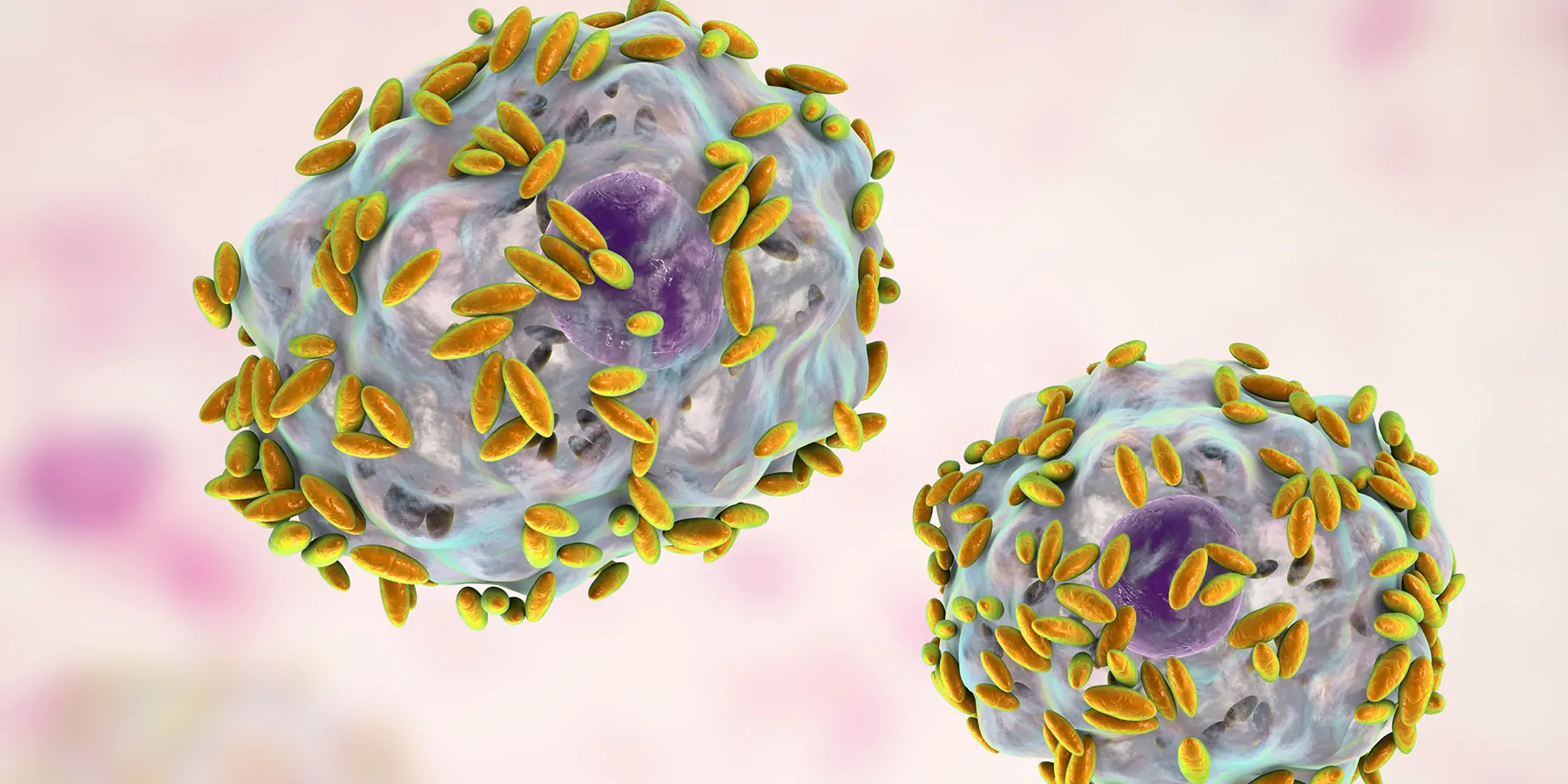 Illustration of microscopic diagnosis of bacterial vaginosis.