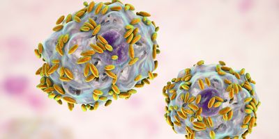 Illustration of microscopic diagnosis of bacterial vaginosis.