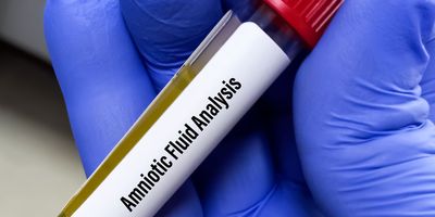 A tube with amniotic fluid for analysis