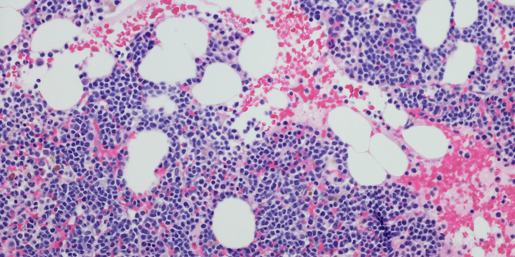 Mouse models show that blocking DUSP6 prevents chronic blood cancer from aggravating into lethal secondary acute myeloid leukemia (sAML).