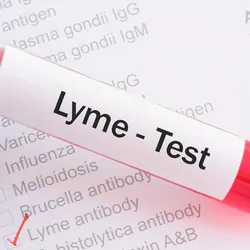 Gloved hand holding a blood sample for a Lyme disease test
