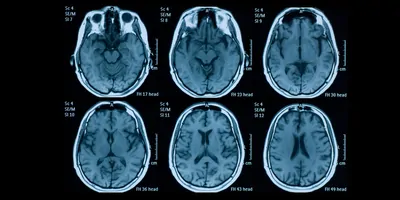 Magnetic resonance images of a human brain