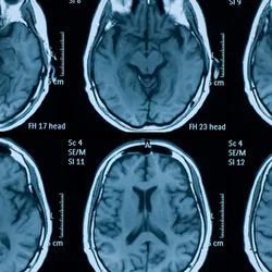 Magnetic resonance images of a human brain
