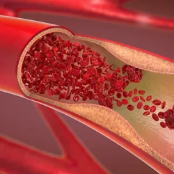 Graphic illustration of an artery, carrying red blood cells, which is narrowing due to accumulation of cholesterol