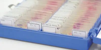 Photo of a box full of breast cancer biopsy slides.
