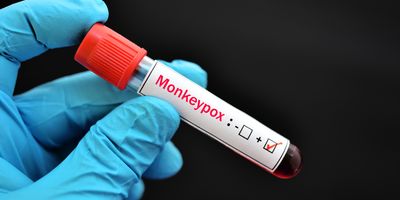 Gloved hand holding a Blood sample tube with positive with Monkeypox virus labeled.