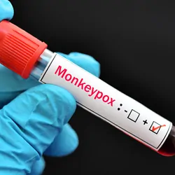 Gloved hand holding a Blood sample tube with positive with Monkeypox virus labeled.