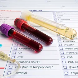 Tubes of blood and urine of a patient with a test report for analysis in the background.