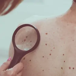 Dermatologist examining spots or moles on the back of a patient