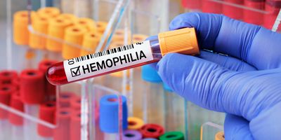 Close-up of a gloved hand holding blood vacutainer with Hemophilia written