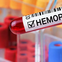 Close-up of a gloved hand holding blood vacutainer with Hemophilia written