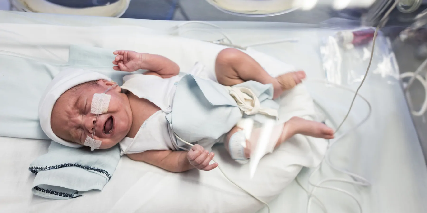A premature baby crying in the NICU with several tubes attached.
