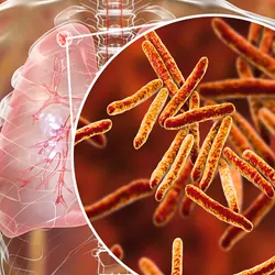 3D illustration of Secondary tuberculosis in lungs and close-up view of Mycobacterium tuberculosis
