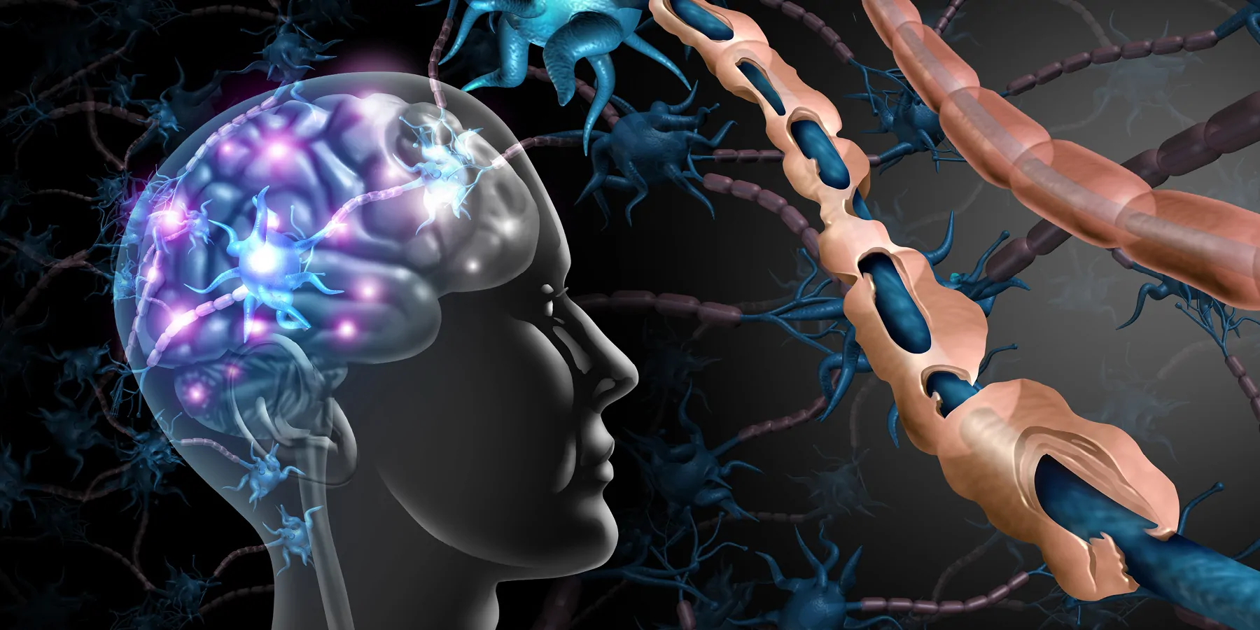 Graphic illustration of multiple sclerosis (MS) and damaged myelin, healthy nerve with exposed fiber, and scarred cell sheath loss.