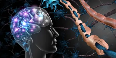 Graphic illustration of multiple sclerosis (MS) and damaged myelin, healthy nerve with exposed fiber, and scarred cell sheath loss.