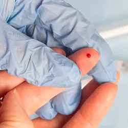 Close-up of blood sampling from a finger prick.