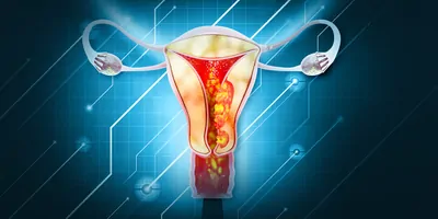 3D illustration of a human uterus showing uterine and endometrial cancer.
