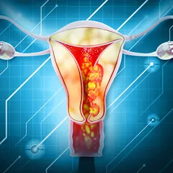 3D illustration of a human uterus showing uterine and endometrial cancer.