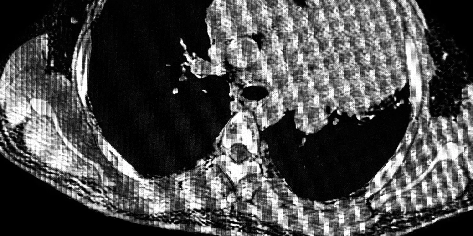 CAT SCAN of a patient with left upper lobe injury showing lymphomatoid granulomatosis