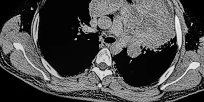CAT SCAN of a patient with left upper lobe injury showing lymphomatoid granulomatosis