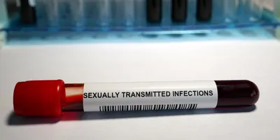 Laboratory analysis performed on a blood sample that is extracted from a vein in the arm using a hypodermic needle and vacutainer to test for Sexually transmitted infection.