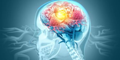 3D Illustration of cancer cells attacking a human brain.