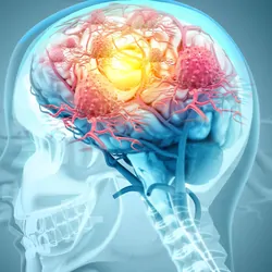 3D Illustration of cancer cells attacking a human brain.