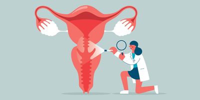 Illustration depicting a health care professional examining the uterus for signs of cervical cancer